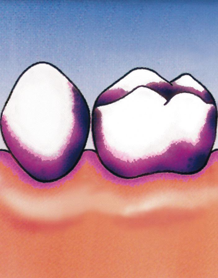Sichtbarmachung der bakteriellen Zahnbeläge.